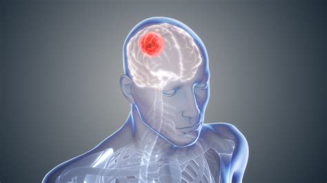 glioblastoma brain tumor cancer